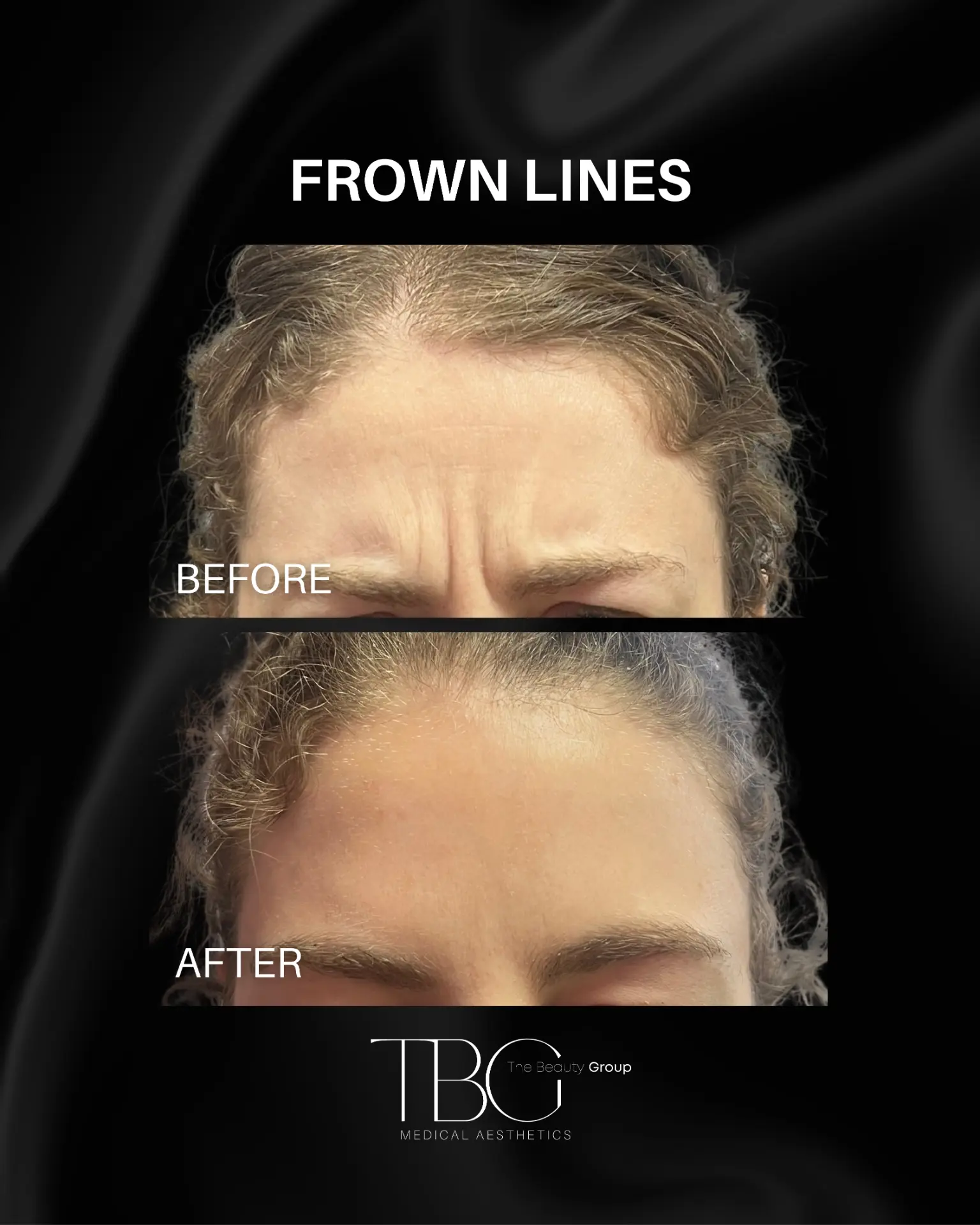 Before and after neuromodulator treatment for frown lines