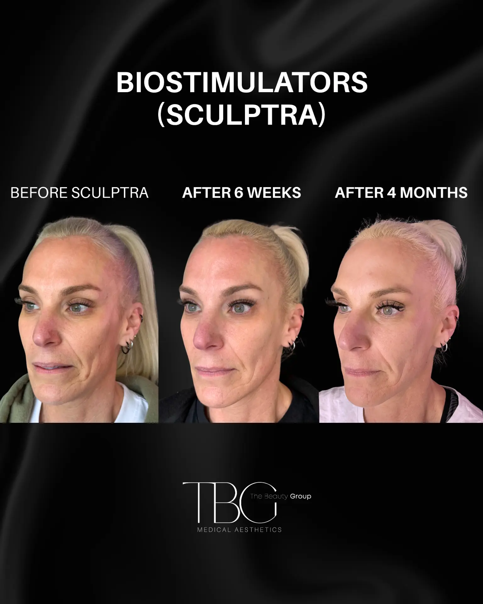 Before and after Biostimulators (Sculptra) treatment showing progressive skin rejuvenation