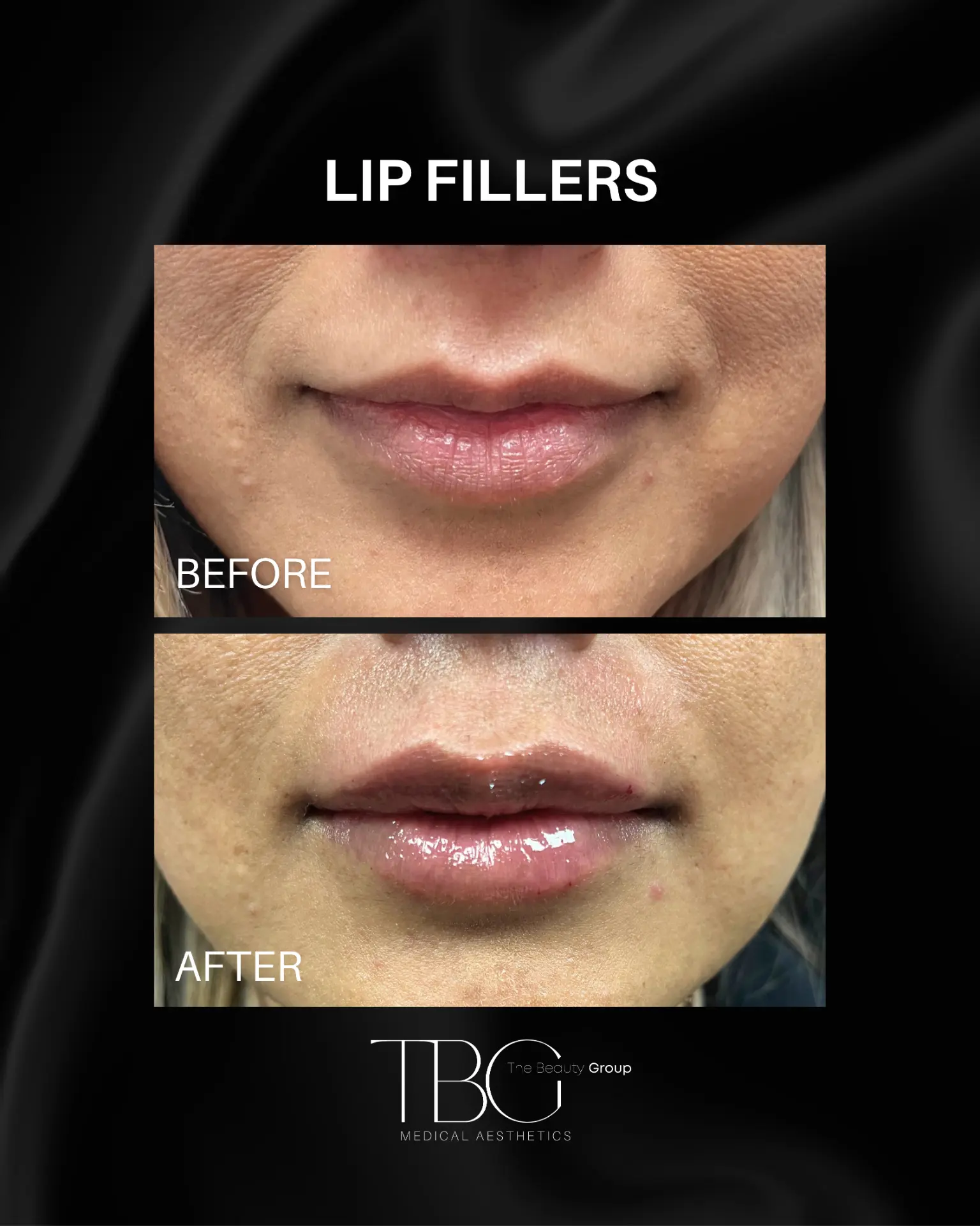Before and after lip filler treatment showing natural lip enhancement