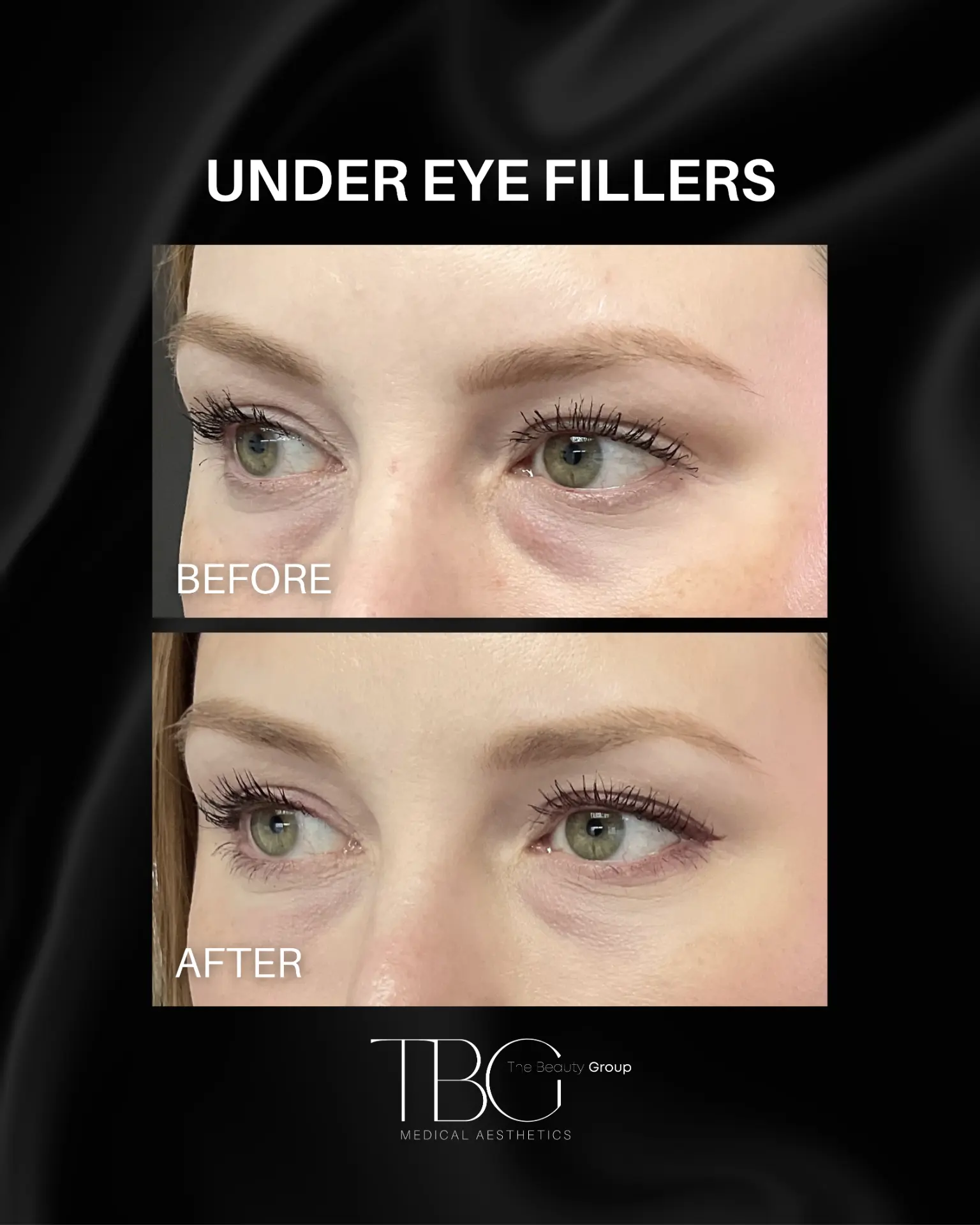 Before and after under eye filler treatment showing a refreshed under-eye area