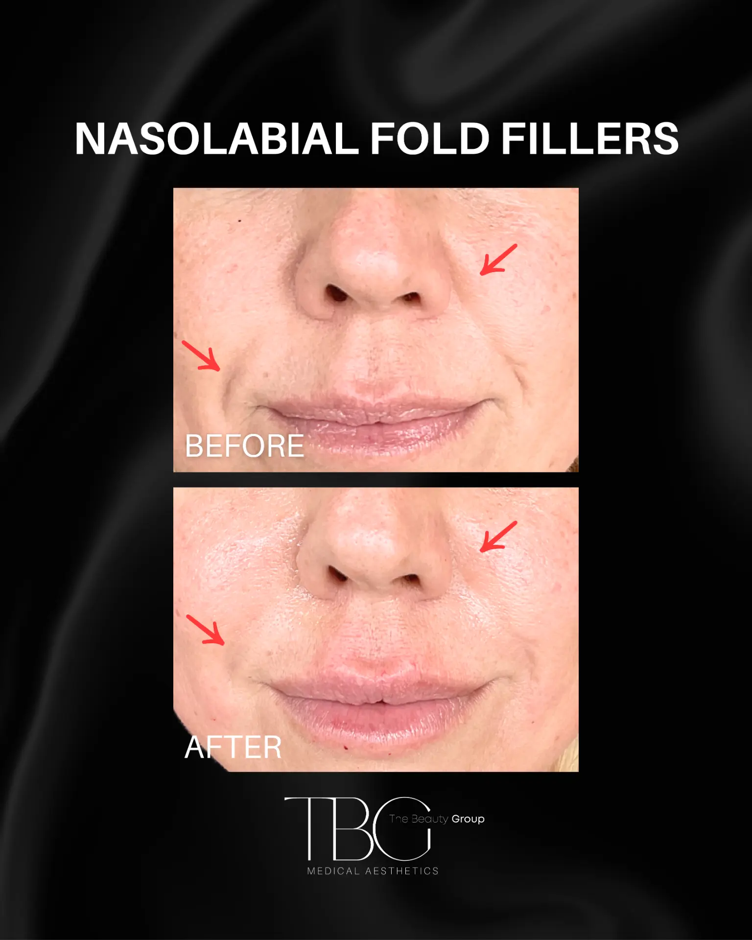 Before and after nasolabial fold filler treatment showing softened smile lines