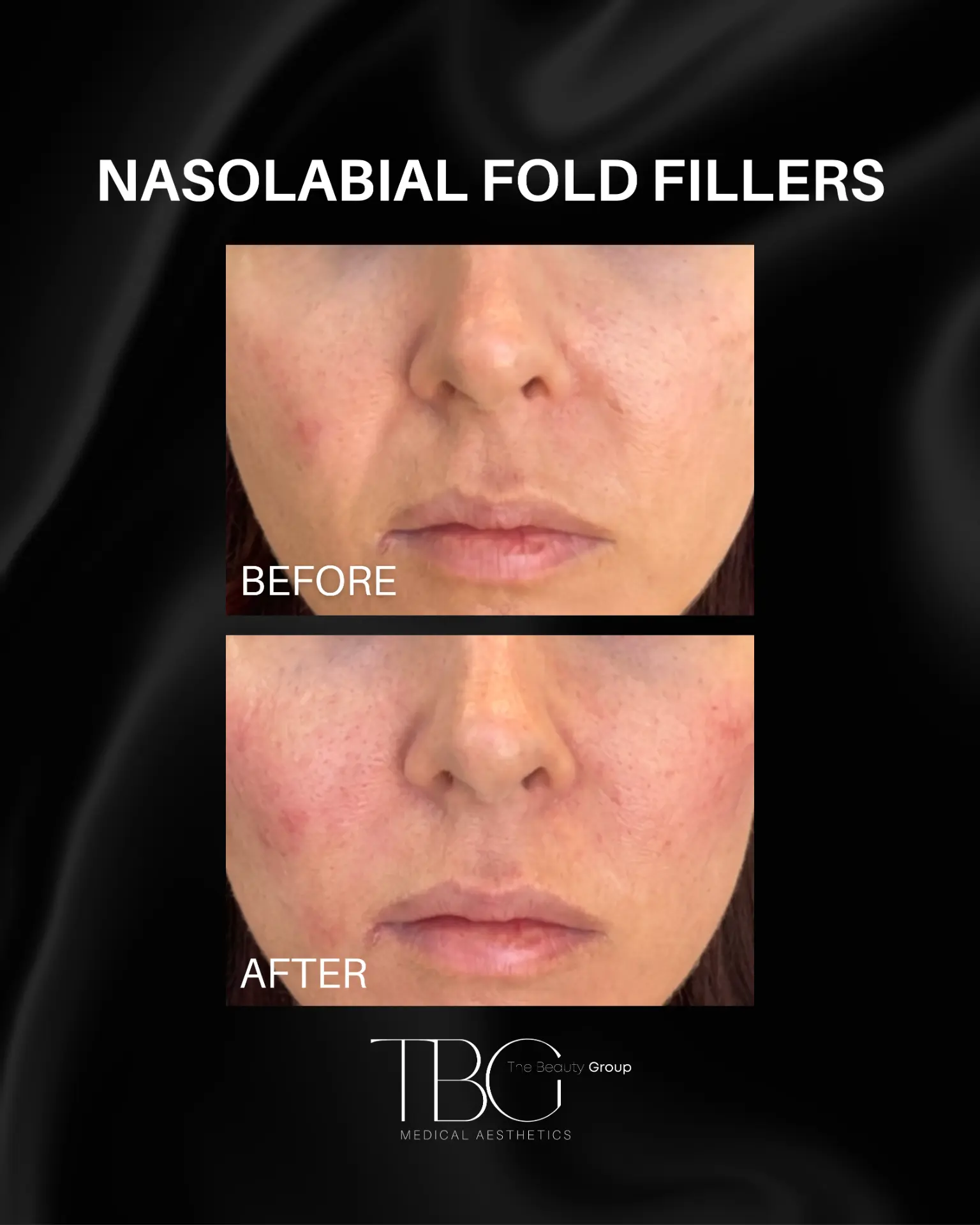 Before and after nasolabial fold filler treatment showing softened nasolabial folds