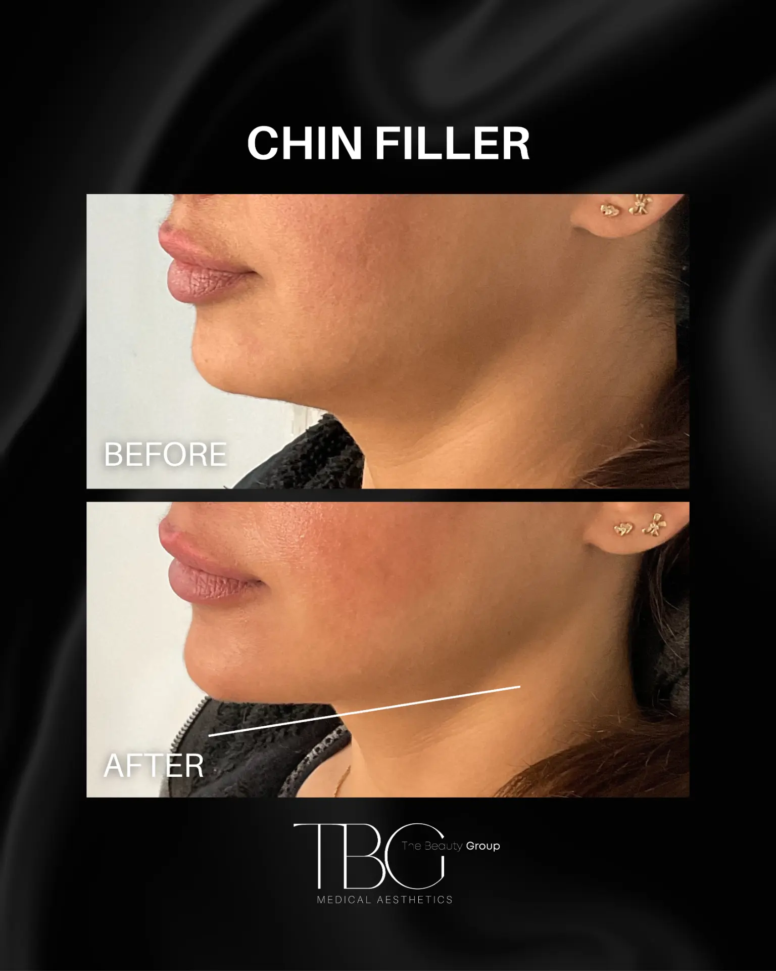 Before and after chin filler treatment showing refined chin definition
