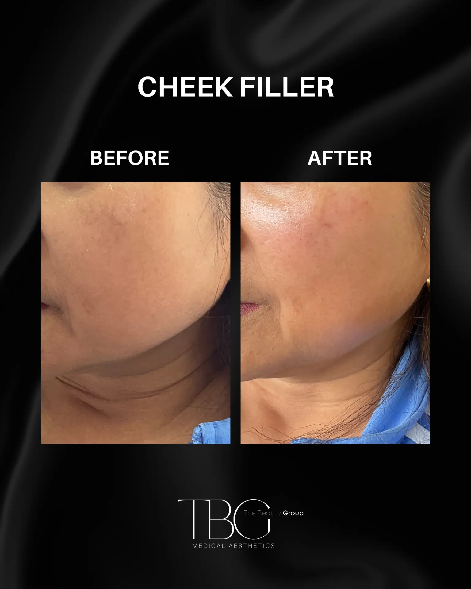 Before and after cheek filler treatment showing enhanced cheek contours