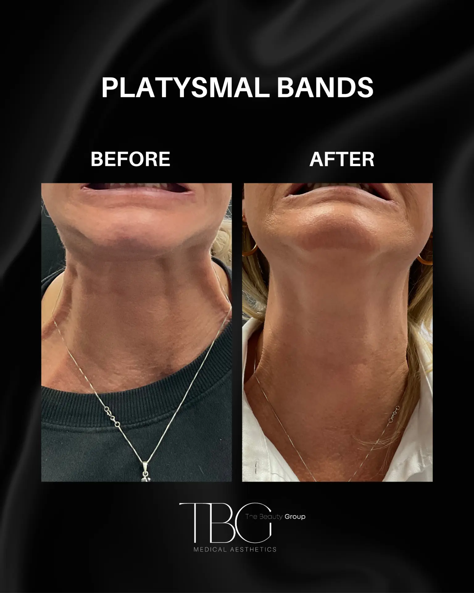 Before and after treatment for platysmal neck bands