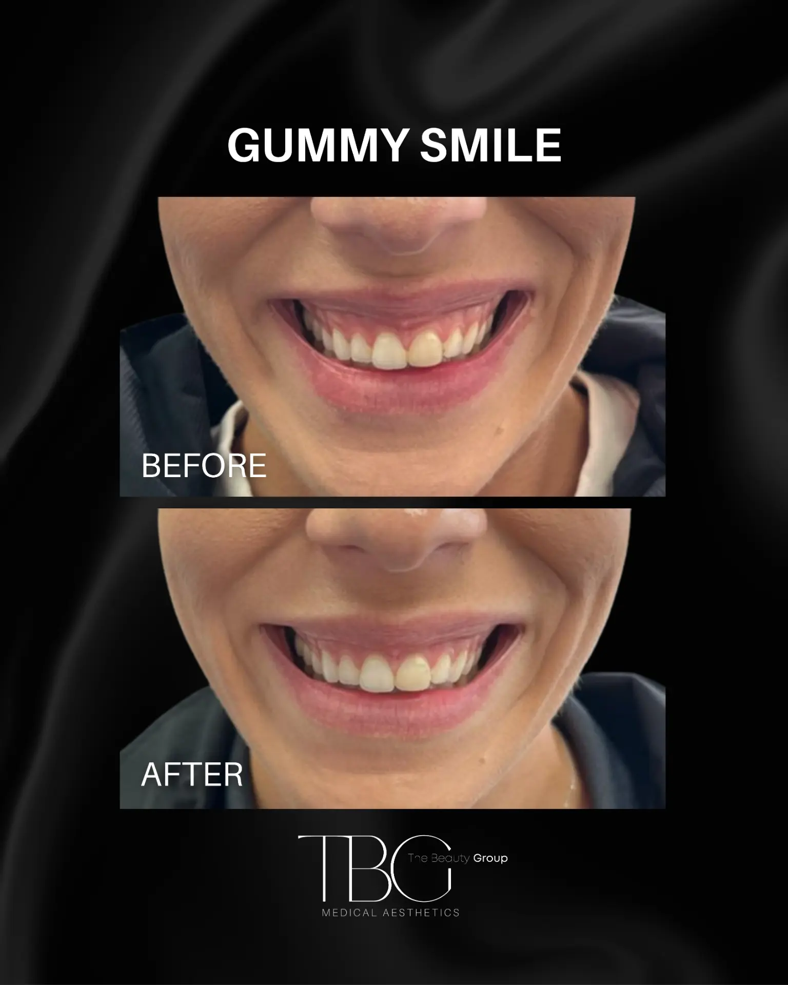 Before and after gummy smile treatment showing a more balanced smile