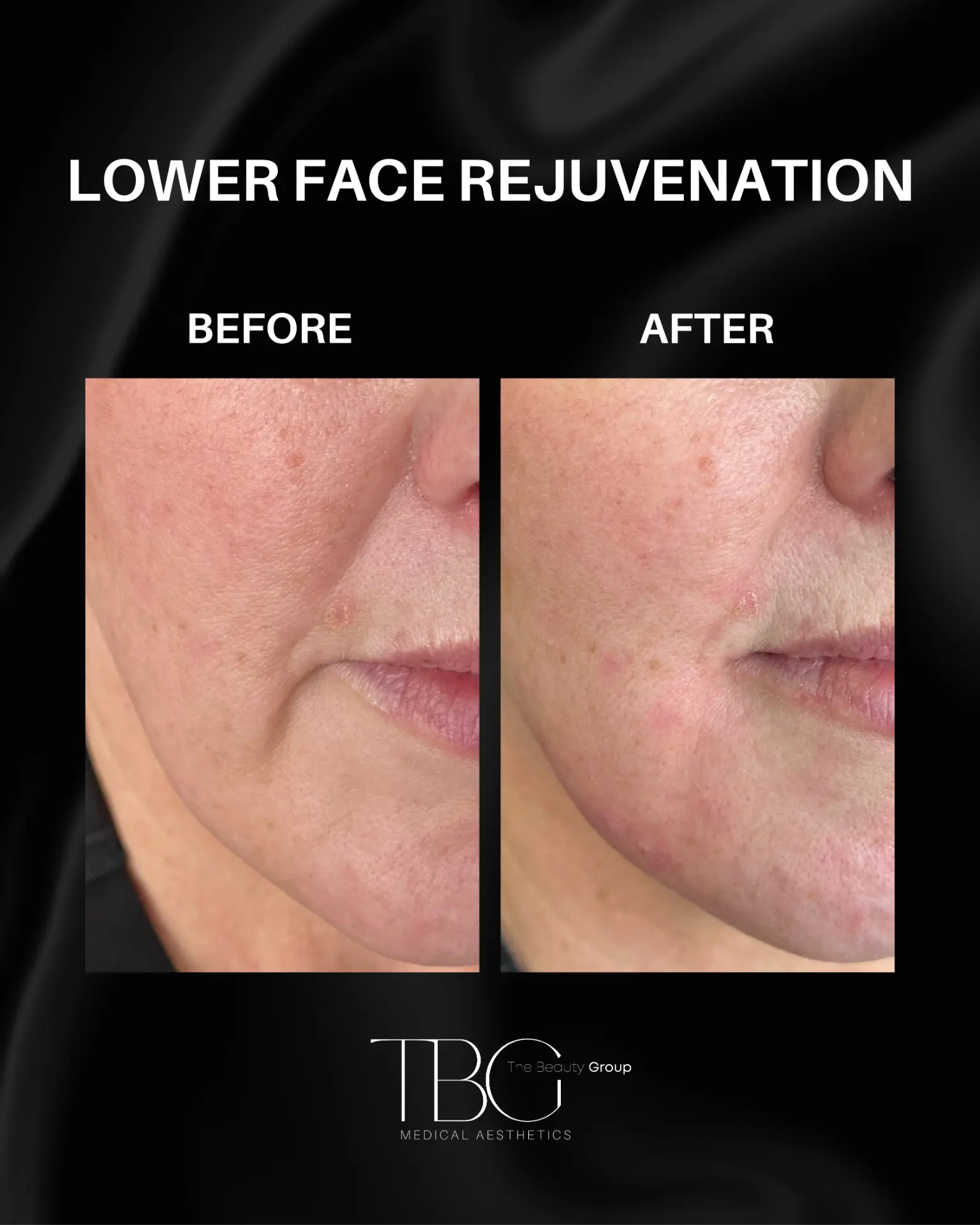 Before and after lower face rejuvenation treatment showing smoother contours