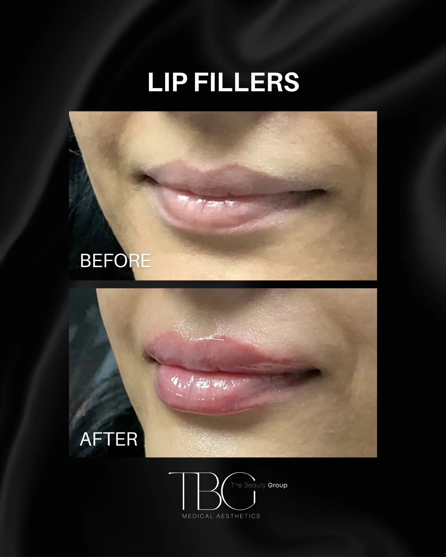 Before and after lip filler treatment showing subtle lip volume