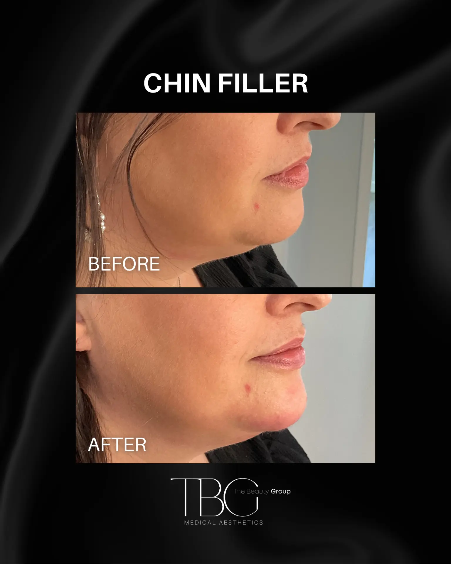 Before and after chin filler treatment showing improved chin projection
