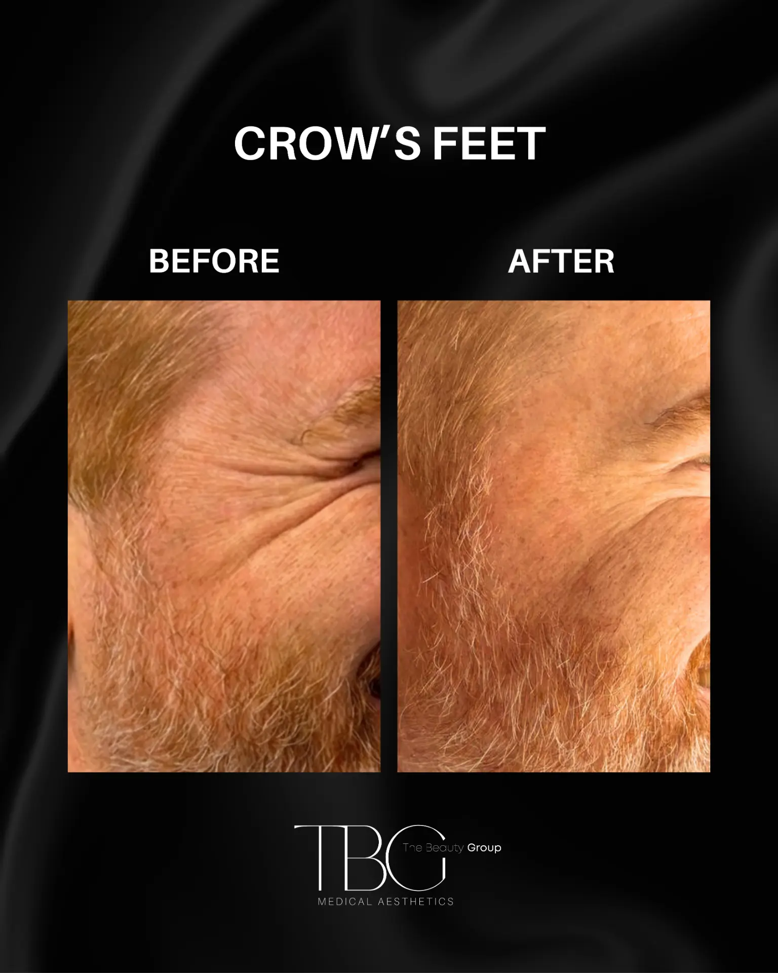 Before and after neuromodulator treatment for crow's feet