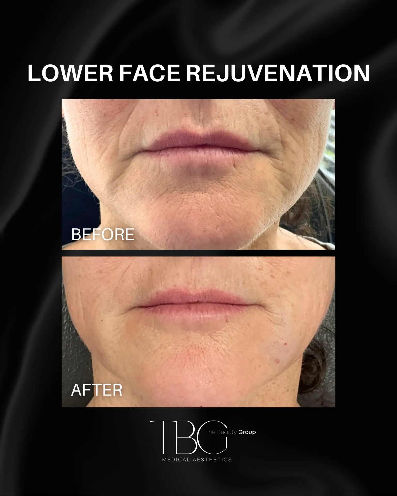 Before and after lower face rejuvenation treatment showing refined lower facial definition