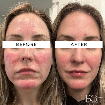Microneedling before and after results showing improved skin texture and reduced redness